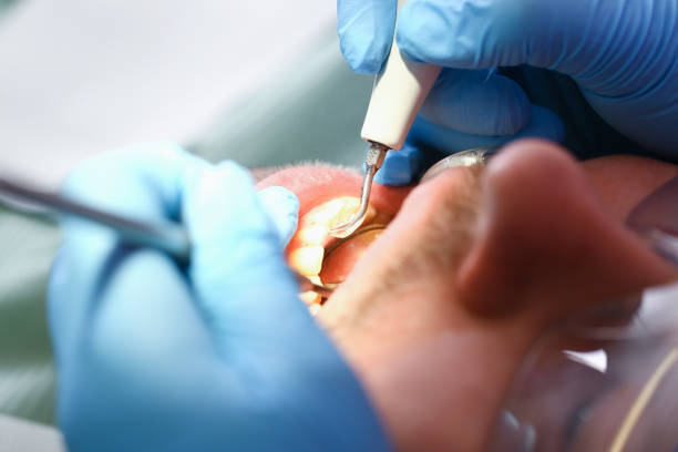 Best Emergency Tooth Extraction in Brentwood, CA